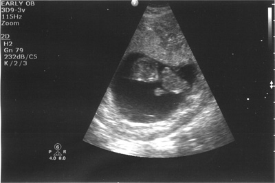 Jon and Leann Olsen Ultrasound of 2nd Olsen Baby
